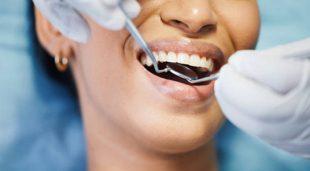 Best Chipped Tooth Repair Near Me  in Florin, CA